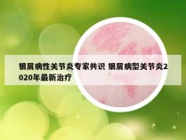 银屑病性关节炎专家共识 银屑病型关节炎2020年最新治疗