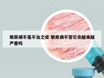 银屑病不是不治之症 银屑病不管它会越来越严重吗