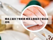 眼皮上面长了银屑病 眼皮上像是长了癣会自愈吗