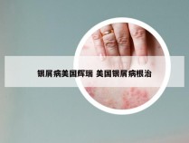 银屑病美国辉瑞 美国银屑病根治