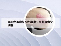 银屑病t细胞和其他t细胞不同 银屑病与t细胞