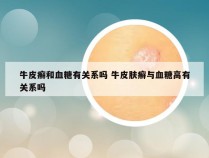 牛皮癣和血糖有关系吗 牛皮肤癣与血糖高有关系吗