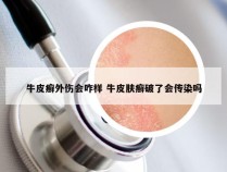 牛皮癣外伤会咋样 牛皮肤癣破了会传染吗