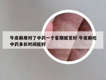 牛皮癣用对了中药一个星期就见好 牛皮癣吃中药多长时间能好
