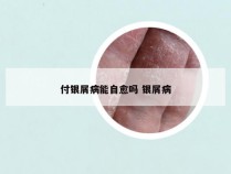 付银屑病能自愈吗 银屑病