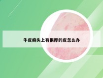 牛皮癣头上有很厚的皮怎么办