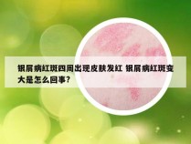 银屑病红斑四周出现皮肤发红 银屑病红斑变大是怎么回事?