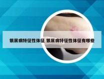银屑病特征性体征 银屑病特征性体征有哪些