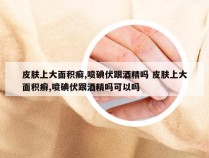 皮肤上大面积癣,喷碘伏跟酒精吗 皮肤上大面积癣,喷碘伏跟酒精吗可以吗