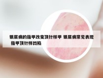 银屑病的指甲改变顶针样甲 银屑病常见表现 指甲顶针样凹陷