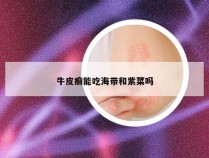 牛皮癣能吃海带和紫菜吗