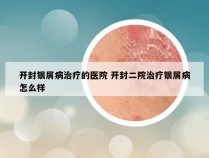 开封银屑病治疗的医院 开封二院治疗银屑病怎么样