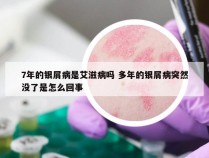 7年的银屑病是艾滋病吗 多年的银屑病突然没了是怎么回事