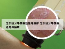 怎么区分牛皮癣还是荨麻疹 怎么区分牛皮癣还是荨麻疹