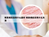 银屑病洗澡用什么最好 银屑病应该用什么洗澡