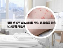 银屑病关节炎b27阳性阴性 银屑病关节炎b27都是阳性吗