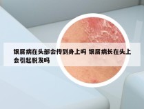 银屑病在头部会传到身上吗 银屑病长在头上会引起脱发吗