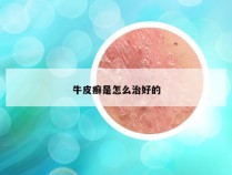 牛皮癣是怎么治好的