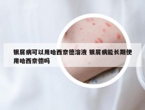 银屑病可以用哈西奈德溶液 银屑病能长期使用哈西奈德吗