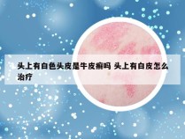 头上有白色头皮是牛皮癣吗 头上有白皮怎么治疗