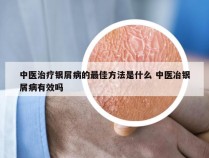 中医治疗银屑病的最佳方法是什么 中医冶银屑病有效吗