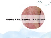 银屑病身上白皮 银屑病身上白皮怎么回事