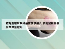 脓疱型银屑病细菌性皮肤病么 脓疱型银屑病有生命危险吗
