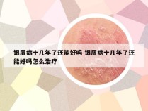 银屑病十几年了还能好吗 银屑病十几年了还能好吗怎么治疗