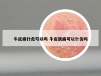 牛皮癣针灸可以吗 牛皮肤癣可以针灸吗