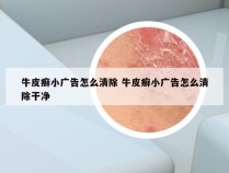 牛皮癣小广告怎么清除 牛皮癣小广告怎么清除干净