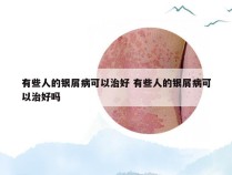 有些人的银屑病可以治好 有些人的银屑病可以治好吗