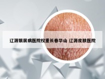 辽源银屑病医院权重长春华山 辽源皮肤医院
