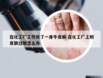 在化工厂工作长了一身牛皮癣 在化工厂上班皮肤过敏怎么办