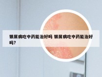 银屑病吃中药能治好吗 银屑病吃中药能治好吗?