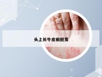 头上长牛皮癣脱发