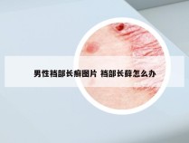 男性裆部长癣图片 裆部长藓怎么办