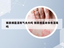 银屑病是湿寒气太大吗 银屑病是身体有湿毒吗
