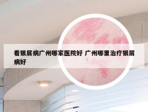 看银屑病广州哪家医院好 广州哪里治疗银屑病好