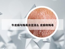 牛皮癣与梅毒会混淆么 皮癣和梅毒