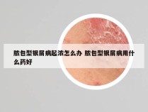 脓包型银屑病起浓怎么办 脓包型银屑病用什么药好