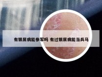 有银屑病能参军吗 有过银屑病能当兵马