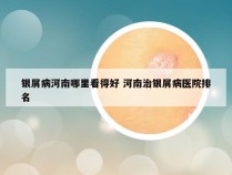 银屑病河南哪里看得好 河南治银屑病医院排名