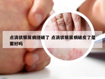点滴状银屑病挠破了 点滴状银屑病破皮了是要好吗