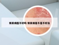 银屑病医不好吗 银屑病是不是不好治