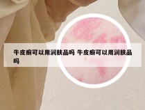 牛皮癣可以用润肤品吗 牛皮癣可以用润肤品吗