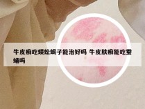 牛皮癣吃蜈蚣蝎子能治好吗 牛皮肤癣能吃蚕蛹吗