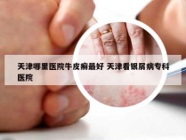 天津哪里医院牛皮癣最好 天津看银屑病专科医院