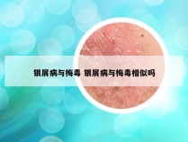 银屑病与梅毒 银屑病与梅毒相似吗
