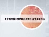 牛皮癣擦廨王喷剂能治去根吗 涂牛皮廨的药