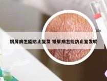 银屑病怎能防止复发 银屑病怎能防止复发呢